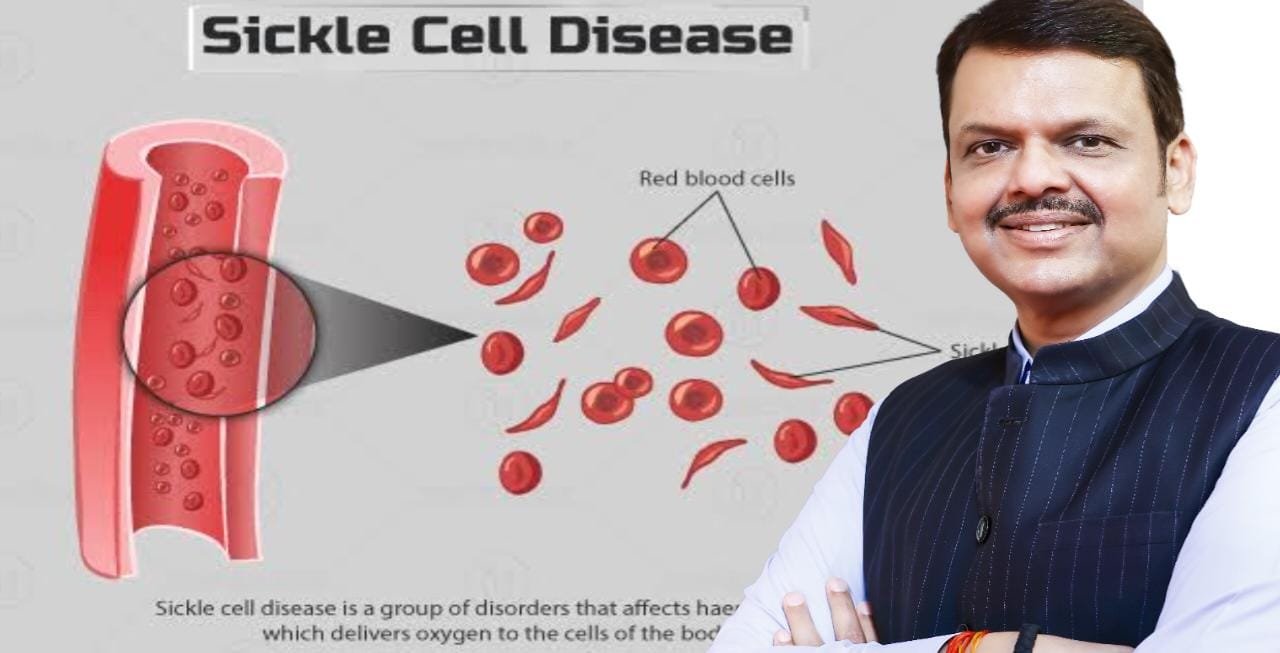 राज्य में सिकलसेल उन्मूलन के लिए विशेष अभियान; 21 जिलों में 100% जांच का लक्ष्य